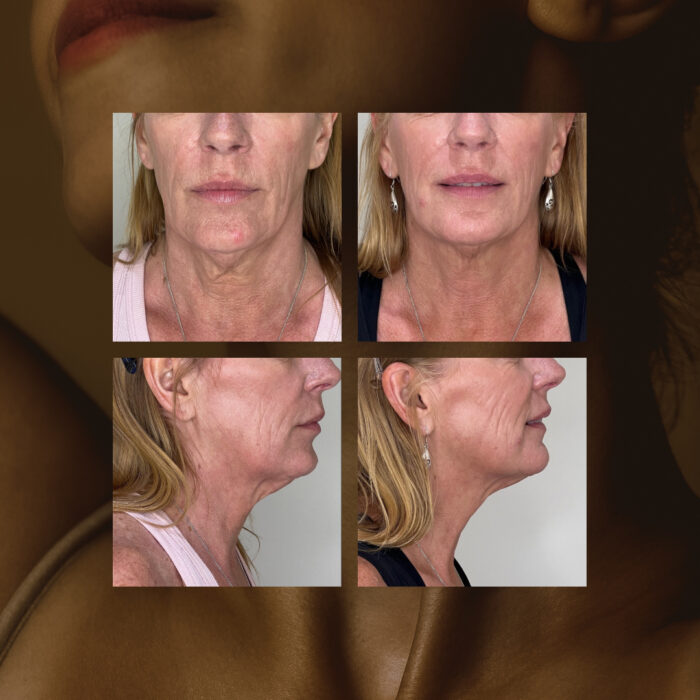 Gold Protocol Treatment Philosophy Md Victoria Bc