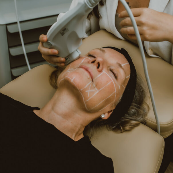 Ultherapy Lower PHI Lift